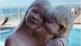 Siostry albinoski podbijają media społecznościowe